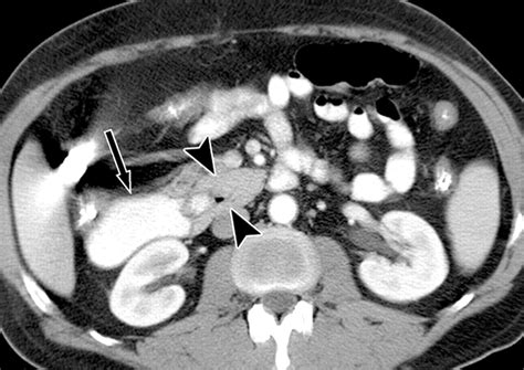 Annular Pancreas In Adults Ajr