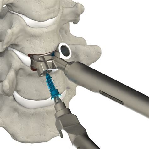 Stand Alone Cervical Spine Truss System 4WEB Medical