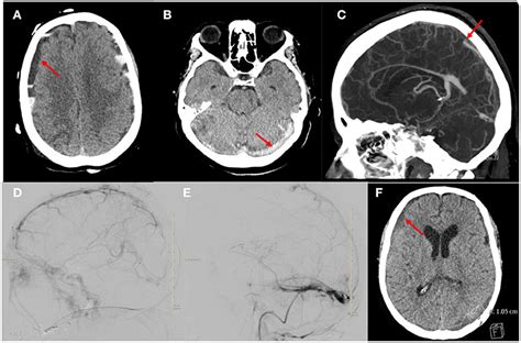 Frontiers Cerebral Venous Sinus Thrombosis With An Acute Subdural