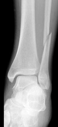 Ankle fracture - Weber C | Radiology Case | Radiopaedia.org