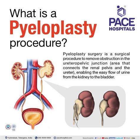 Pyeloplasty Surgery in Hyderabad - Procedure Indications, Types & Cost