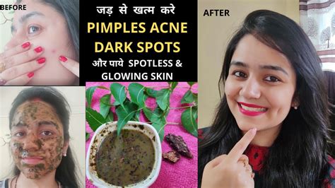 How To Get Rid Of Acne Pimples Naturally In Days Neem Ki Chaal Ka