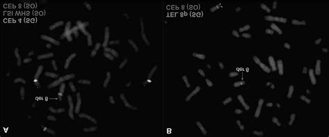 Proband Fish Analysis A Using Centromere Probes And D Z And