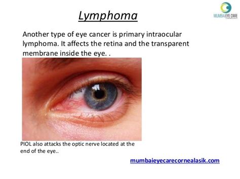 Symptoms Of Eye Cancer