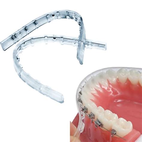 5 Benefits of Comfort Lip Bumper Braces for a Comfortable Orthodontic ...