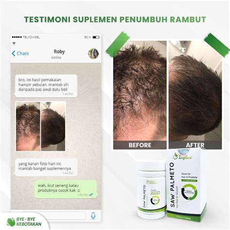 Beautypedia Suplemen Penumbuh Rambut Botak Rontok Parah Green Angelica