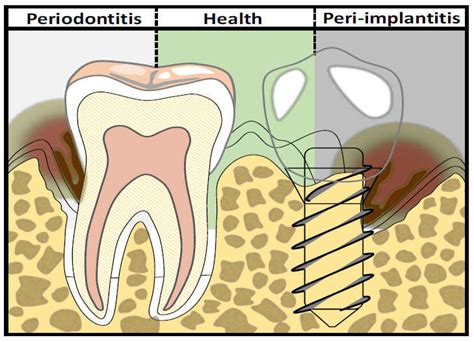 Periodontal Health Versus Periodontitis Around Natural Tooth Structure