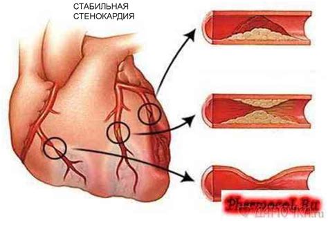 Заболевания сердечно-сосудистой системы - online presentation