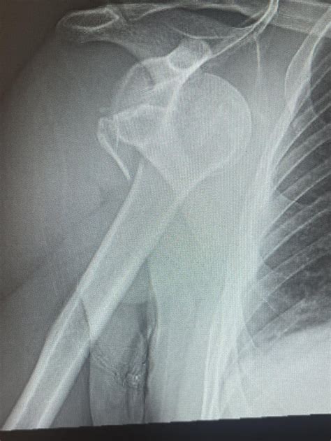 Shoulder Surgery? : r/Orthopedics