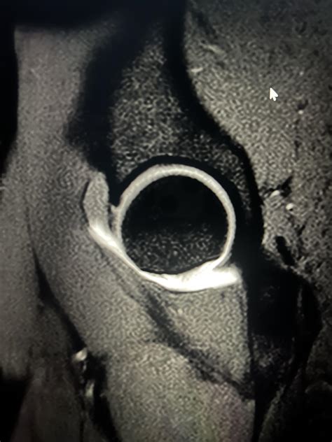 Is this a hip labrum tear? : r/medical