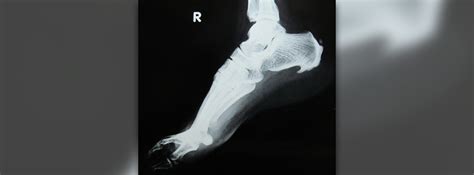 What causes bone spurs | General center | SteadyHealth.com