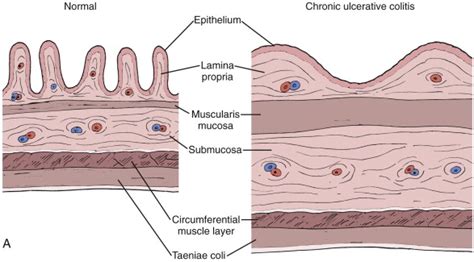 What Is Mucosa Ileocecal Valve - Infoupdate.org