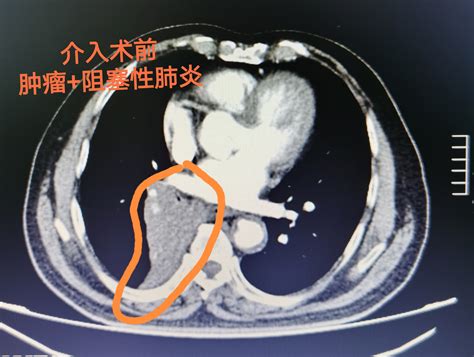 一例肺癌的微创介入治疗 温晓斐 爱问医生