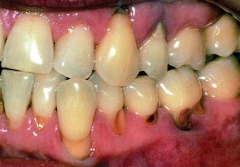 Mayor A De Mexicanos Tiene Caries O Enfermedades Periodontales Viardenlab