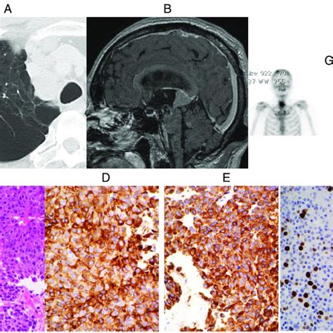 Period from tissue diagnosis of the primary neuroendocrine tumor until ...