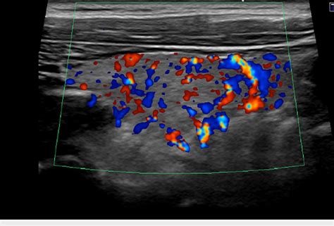 Thyroid Ultrasound Of Case 1 Long Axis With Doppler Showing Increased