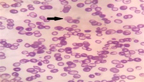 Peripheral Blood Smear Shows Giant Platelets Black Arrow Surrounded