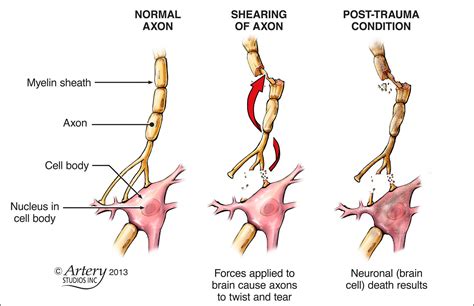 Diffuse axonal shearing: when