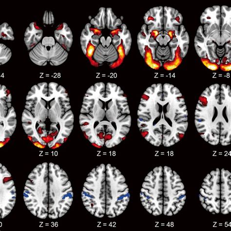 The Group Level Activation Maps Of Group One In The Facial Expression