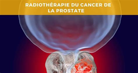 La radiothérapie pour traiter le cancer de la prostate