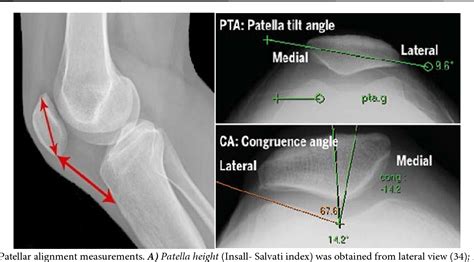 Patellofemoral Joint Xray