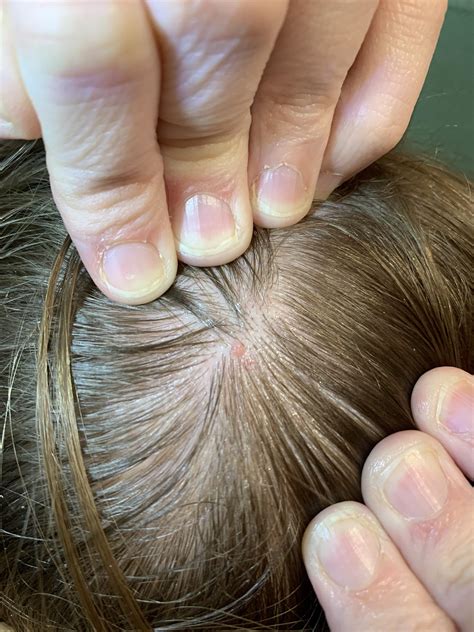 Nodular Melanoma on Scalp? : r/Melanoma