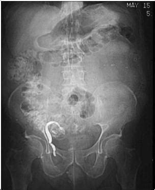 Learningradiology Abdominal Pain