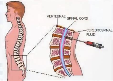 Guillain-Barre Syndrome – Symptoms, Causes, Treatment, Pictures | hubpages