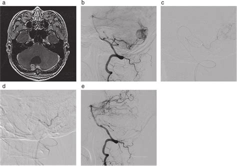 Contrast Enhanced MR Images And Right Vertebral Angiogram In Case 6