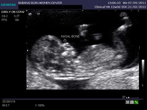 Ultrasound Nuchal Translucency