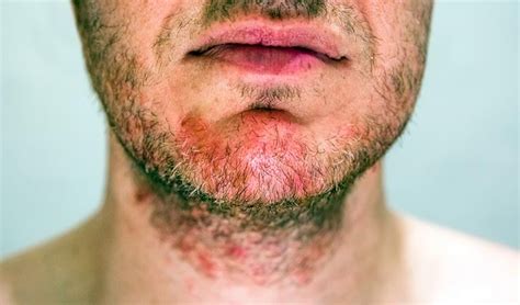 Dermatitis Seborreica Qu Es S Ntomas Y Tratamiento