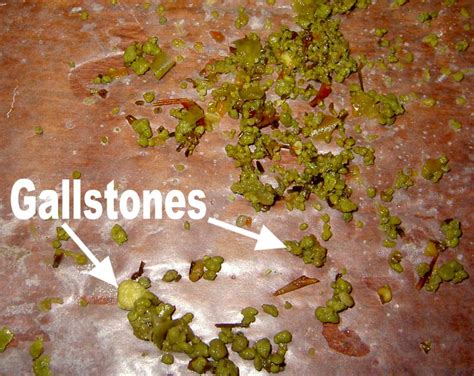 Dynamic Views On Health Def Read Gallstones