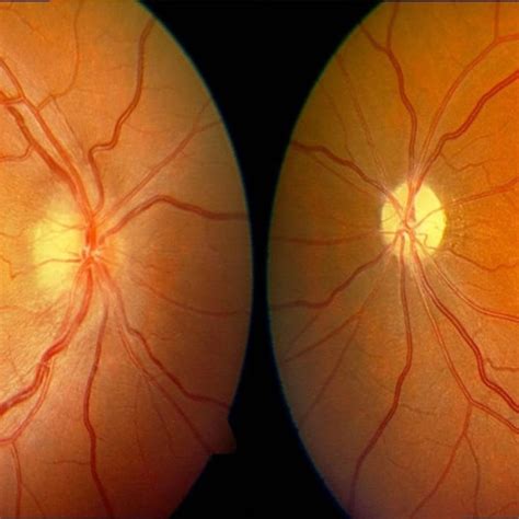 Fundus picture of both eyes showed optic disc edema in the right eye ...