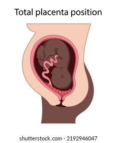 Different Placental Locations Fetus Uterus During Stock Vector Royalty