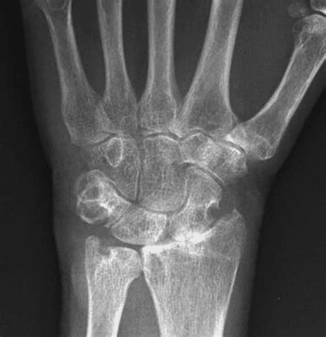 Typical Sites Of Osseous Erosion Of A Rheumatoid Wrist Shown Here