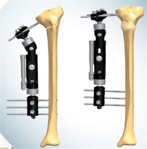 Quais S O Os Tipos De Fixadores Ortop Dicos