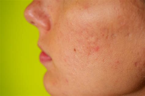 Cravos E Espinhas Saiba Como Evitar O Aparecimento Da Acne