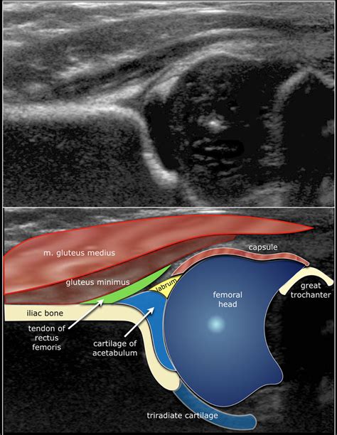 Neonatal Hip Ultrasound