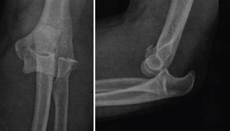 Inestabilidad traumática aguda de codo FONDOSCIENCE