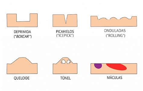 Tipos De Cicatrices Y Marcas De Acné Didac Barco