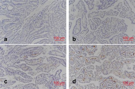 Prostate Specific Membrane Antigen Expression Negative A Weak B