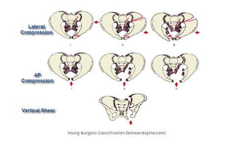 Classification Of Pelvic Fracture