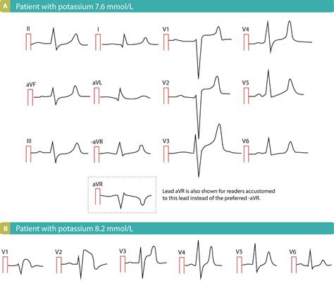 ECG Changes Due To Electrolyte Imbalance Disorder Cardiovascular