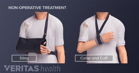 Treating A Clavicle Fracture