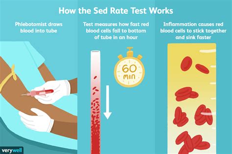 Segarkan Pengetahuan Anda Tentang Tingkat Sedimentasi Sed Rate Hasil