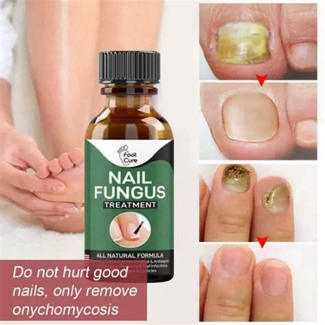 FUNGAL NAIL REPAIR Essence Care Onychomycosis Serum Fungal Nail