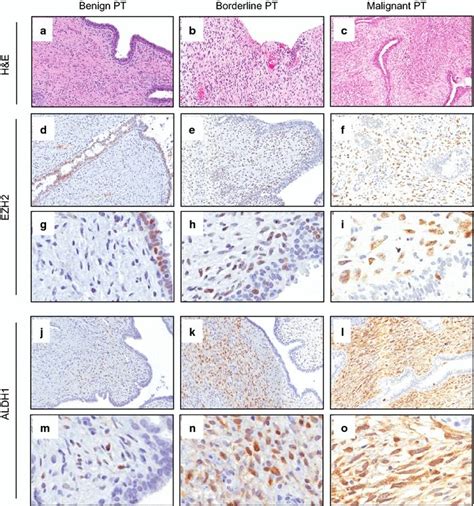 Immunohistochemical Staining Of Ezh2 And Aldh1 In Pts Of The Breast