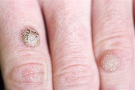 7 Ways Get Rid Of Warts Wart Removal A2z Healthy