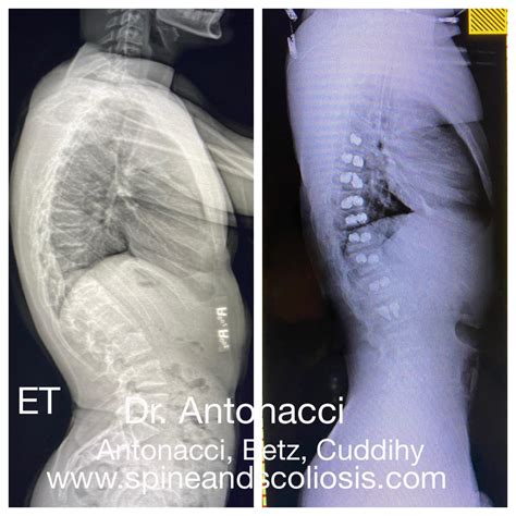 Anterior Scoliosis Correction ASC