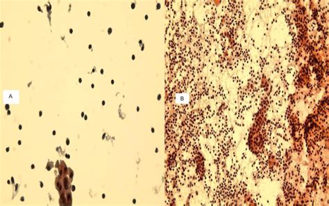 A A Tp Slide Of Chronic Thyroiditis Of Thyroid Fna Showing Many